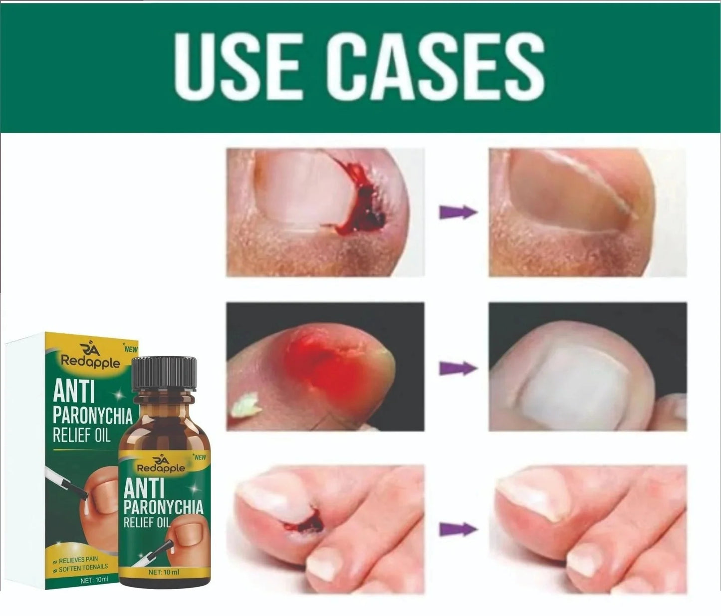 Anti Paronychia Relief Oil - Buy 1 Get 1 FREEš„